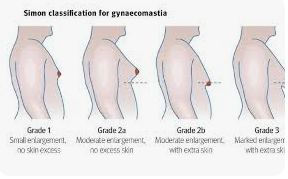여유증 증상, 원인, 수술가격, 여유증 개선 운동 총정리