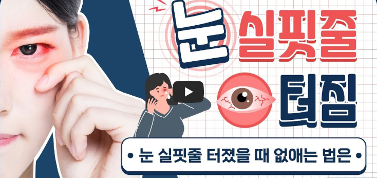 눈 실핏줄이 터지는 이유는? 원인 & 예방법 총정리 - 눈 실핏줄이 터지는 원인 - 6. 음주 & 흡연 눈 실 핏줄 터졌을 떄 없애는 법