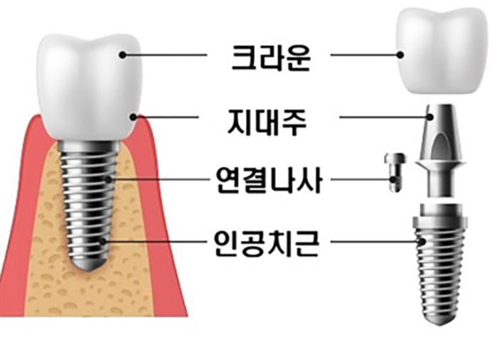 나사형 임플란트 구조