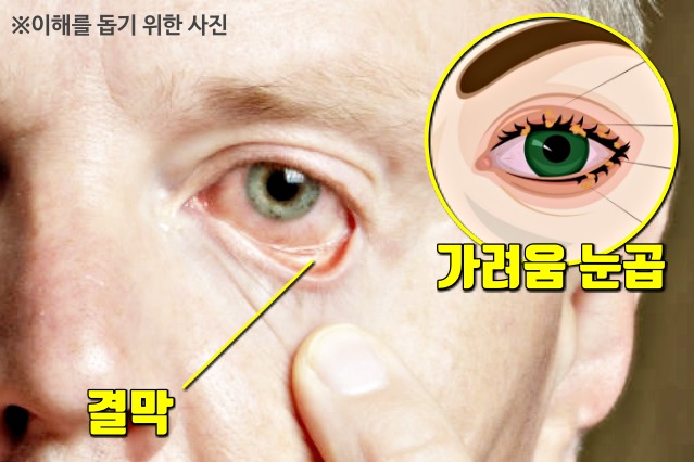 눈병 결막염 증상 원인, 여름에 많이 걸리는 병, 건강 팁줌 매일꿀정보