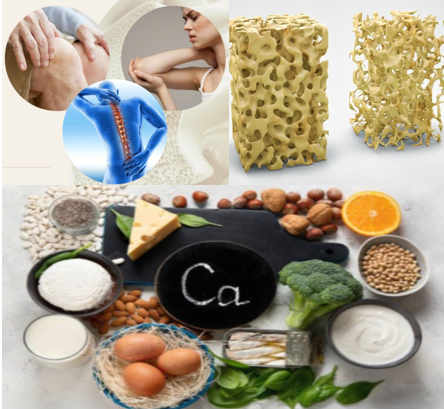 골다공증의 원인 및 좋은음식을 통한 관리