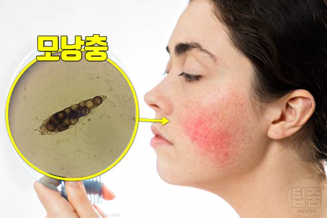 얼굴 붉은기 원인 얼굴 빨개지는 이유 얼굴홍조 원인 주사피부염 장미진