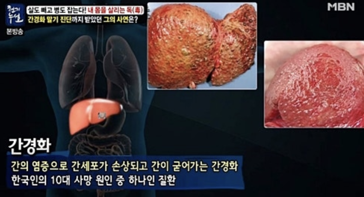 간경화 초기증상 10가지 총정리 섬네일