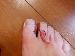 내성발톱 자가치료