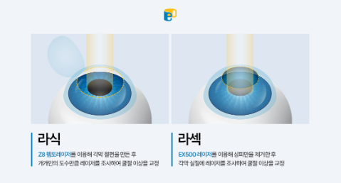 라섹 후기