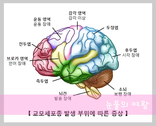눈물의 여왕 클라우드 세포종 증상