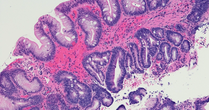 장상피화생 세포