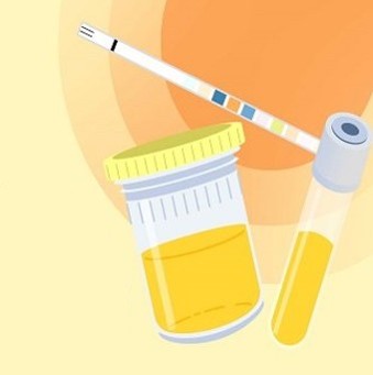 소변색이-노랑색으로-검사해보고-있는-모습