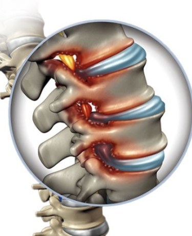 척추관협착증 증상 1