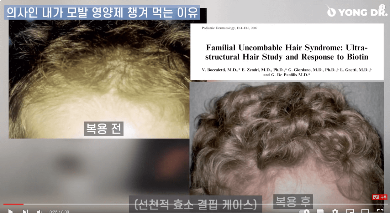 탈모에 