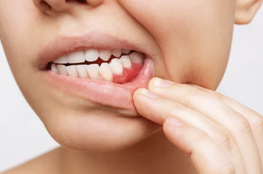 잇몸이 붓고 아픈 모습