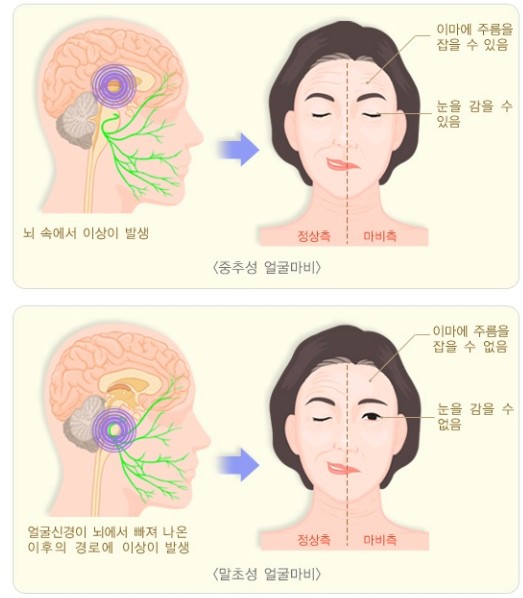안면신경장애