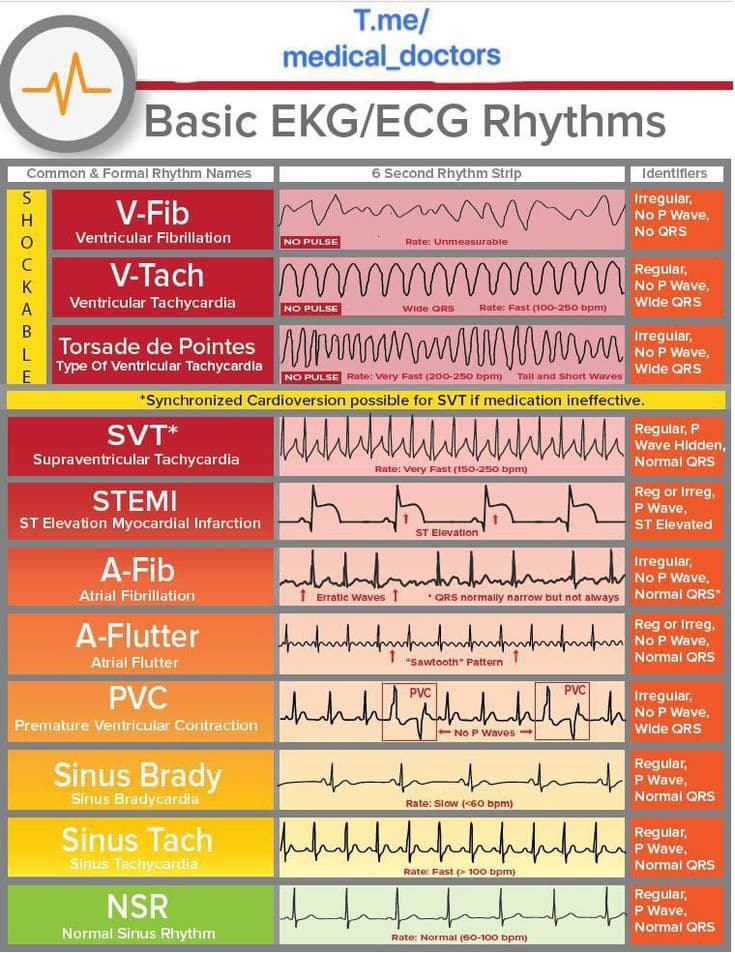 EKG 리듬