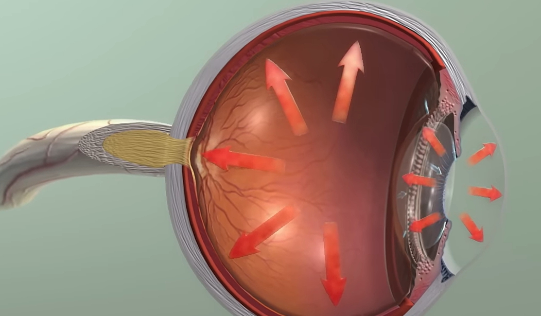 녹내장 초기증상