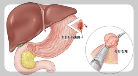 절개술 사진