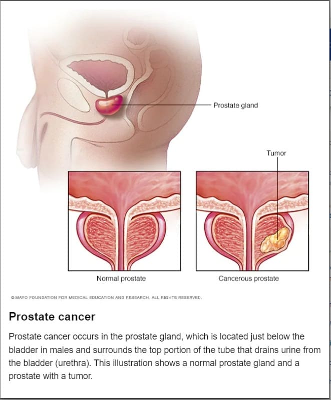 중년남성의 적 '3대 비뇨기암' Prostate cancer