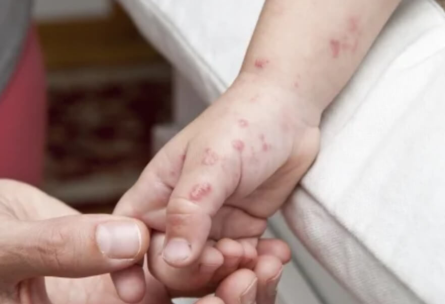 대상포진 초기증상 대상포진 조기치료 대상포진 초기증상 및 조기치료