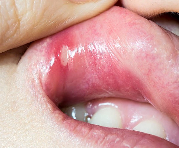 구내염 전염