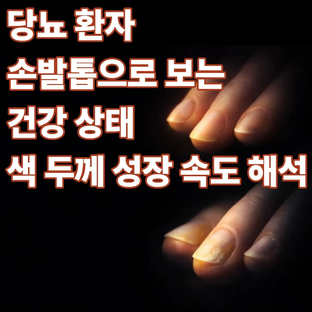 당뇨 환자 손발톱으로 보는 건강 상태: 색&middot;두께&middot;성장 속도 해석