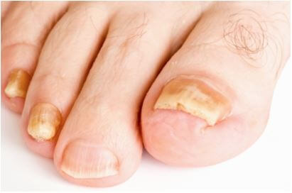 발톱 무좀 상태