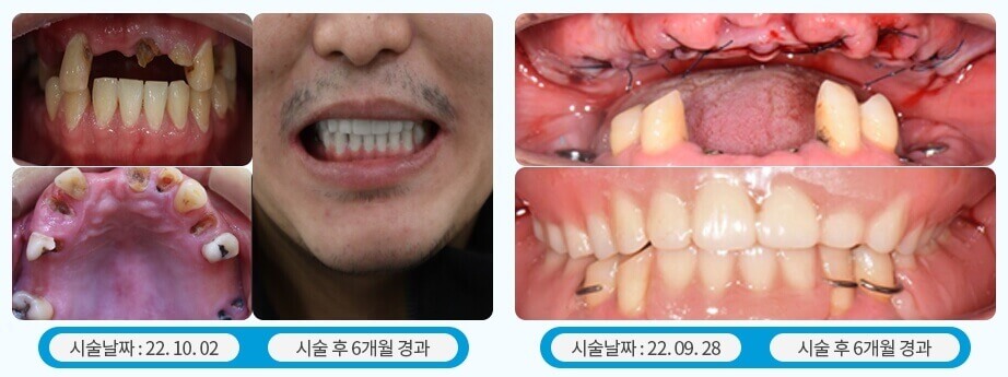임플란트 시술 전과후 사진