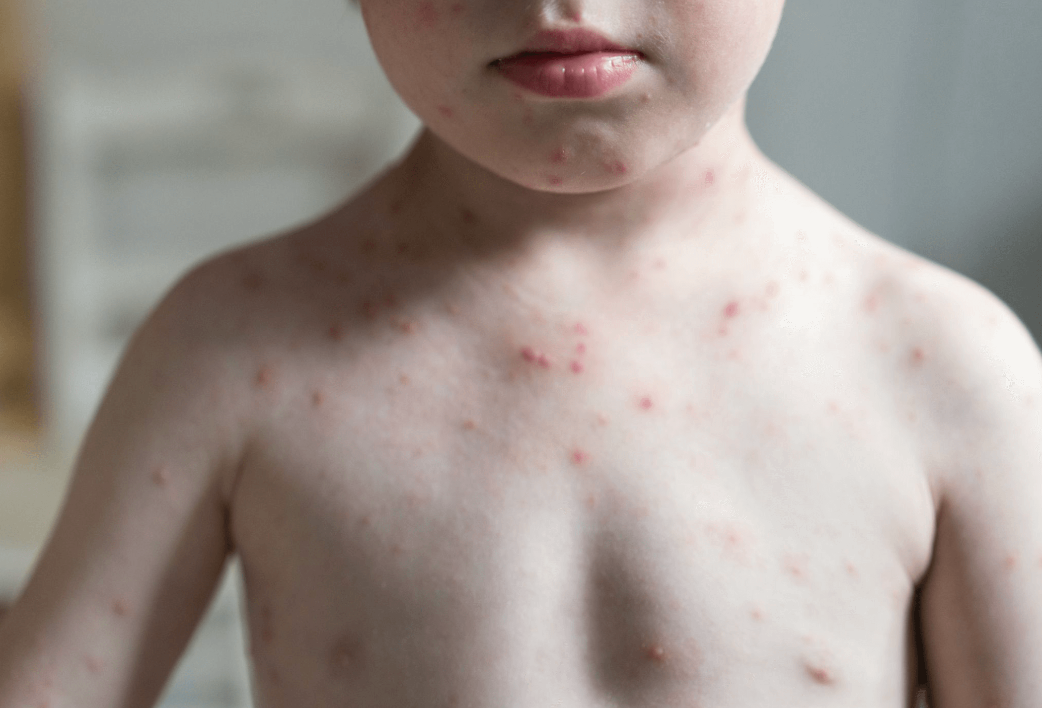 원숭이두창 증상