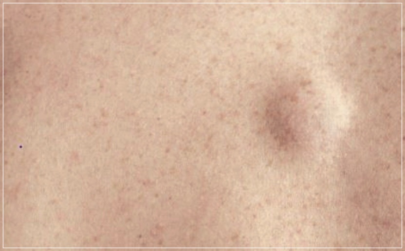 지방종 제거 수술: 원인, 절차, 비용