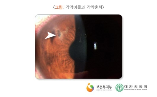 각막혼탁