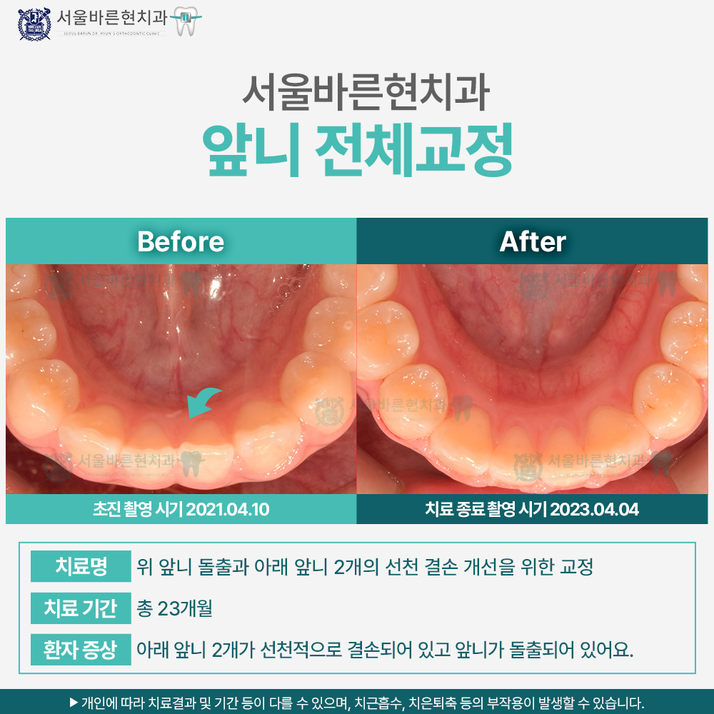 부산앞니교정
