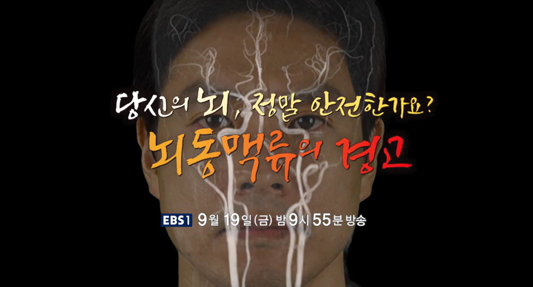명의 뇌 뇌동맥류