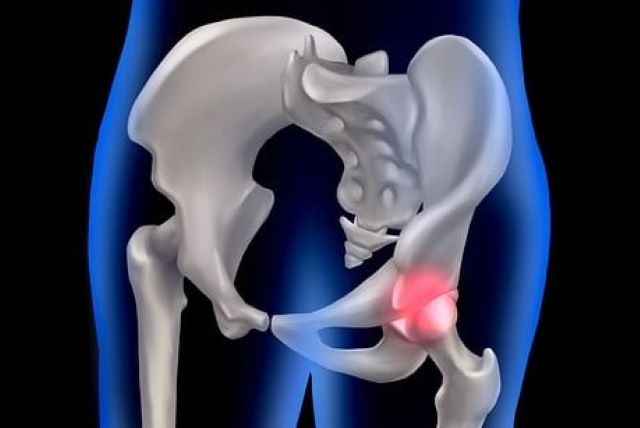 노인성 골절의 심각성을 다루고 설명하고 있습니다.