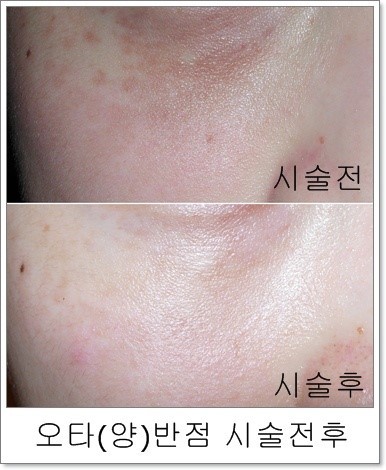 엔디야그 레이저 시술전후