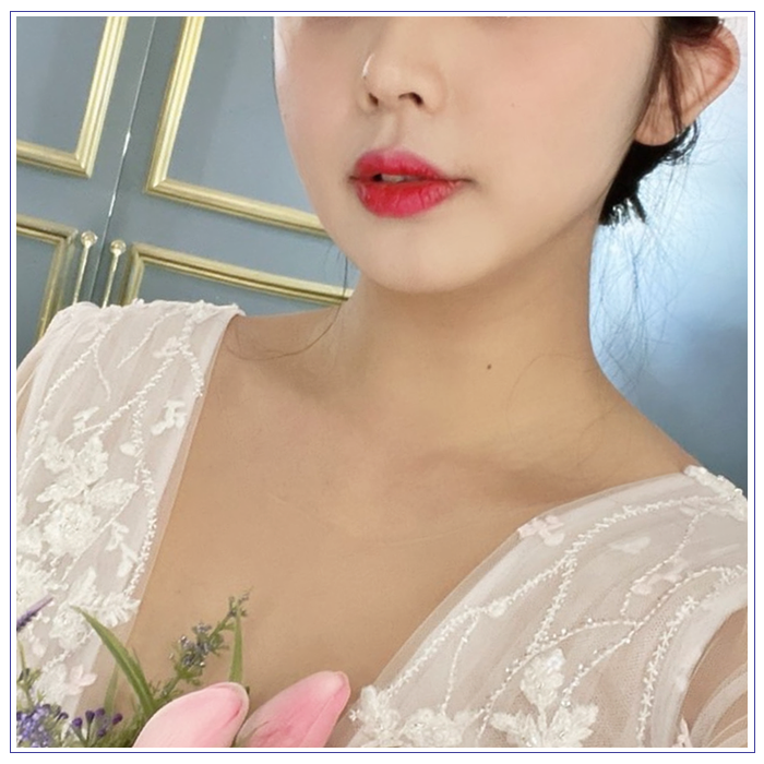 윤곽주사 후기