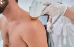 검버섯 레이저 치료 비용