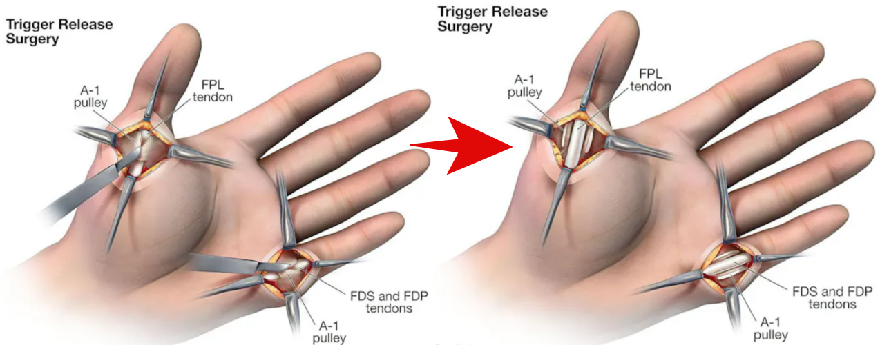 방아쇠수지수술-트리거핑거수술