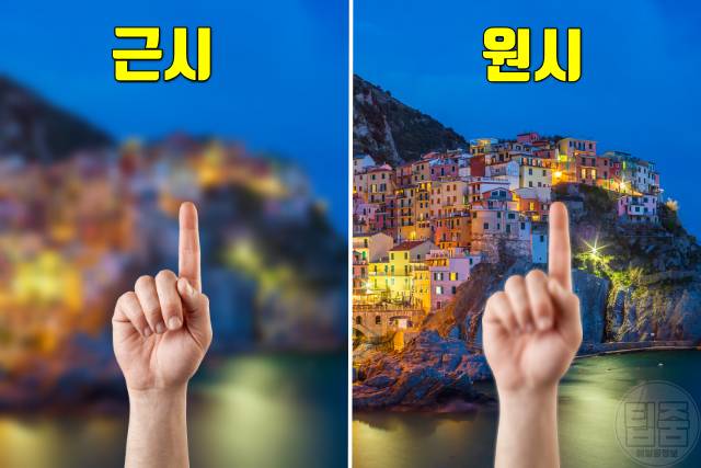 녹내장 원인 녹내장 실명확률 근시