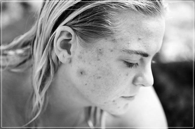 얼굴 여드름 부위별 발생 원인