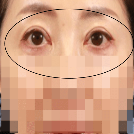 실리프팅을 받은 뒤 여성의 모습 사진