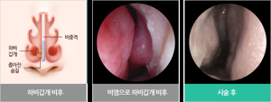 비염 수술