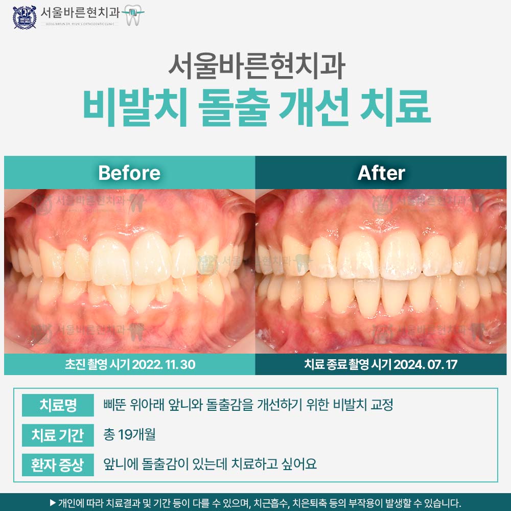 부산치아교정