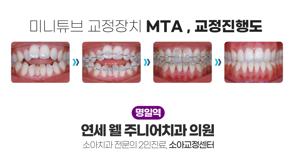 어린이 MTA 교정 전후 치아 배열 변화와 교정 진행 과정