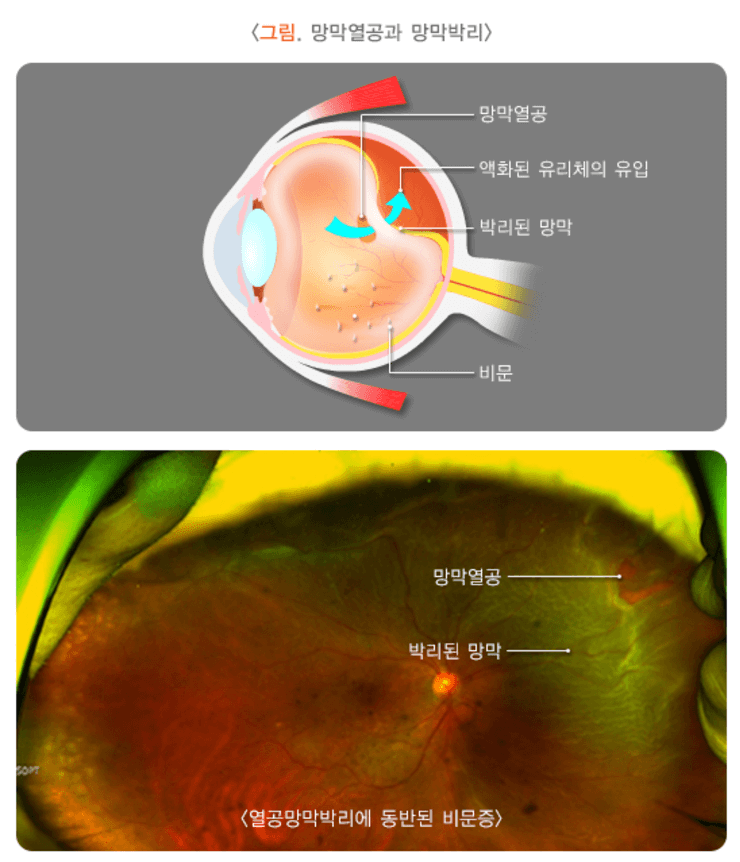 비문증 치료방법 원인 좋은 음식