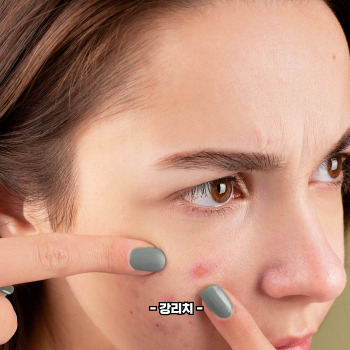 여드름 흉터 없애는 법