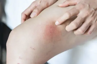 하지 정맥류 증상 30