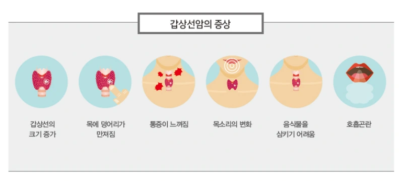 갑상선 유두암 증상