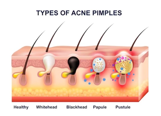 화농성 여드름 관리법 총정리