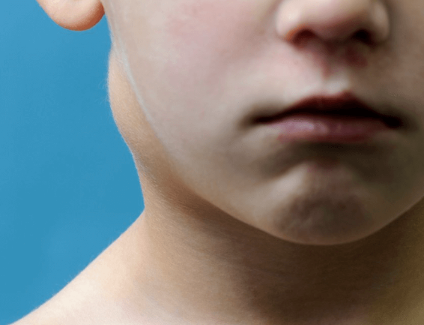 왜 임파선염이 생기는 걸까?