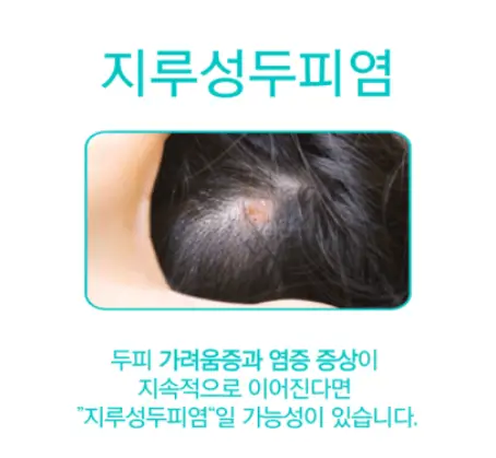 지루성두피염