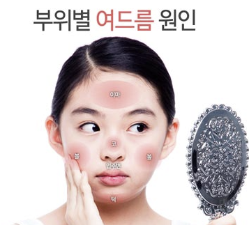 여드름원인