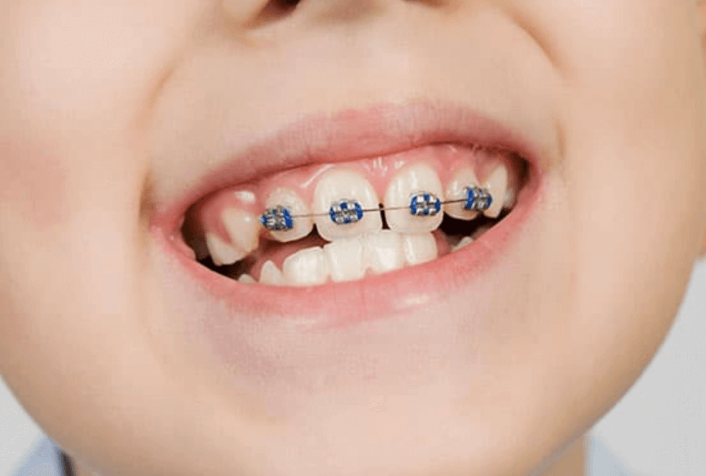 앞니 벌어짐